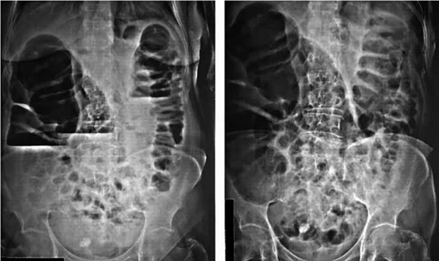 Mulher de 69 anos foi atendida por queixa de dor em cólica e inchaço abdominal há 5 dias. Há um mês vinha notando afilamento das fezes, mas parou de evacuar há uma semana. Ao exame do abdome, notou-se timpanismo difuso e ruídos hidroaéreos aumentados. No raio X simples de abdome, pode-se observar o aspecto das alças intestinais. Qual é a hipótese diagnóstica e qual é a conduta?